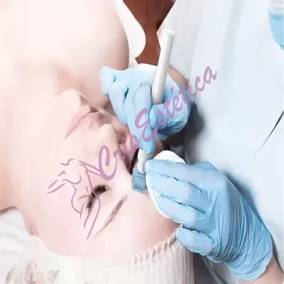 dermaroller-s1-microagulhamento-profissional