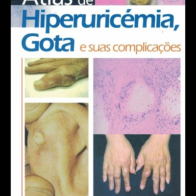 Atlas de Hiperuricémia, Gota e suas Complicações