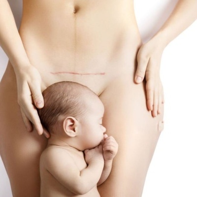 O mel de grau médico: uma alternativa promissora aos antibióticos na prevenção de infeções após cesarianas