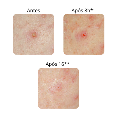 IROHA NATURE | Adesivos Eliminador SOS de borbulhas