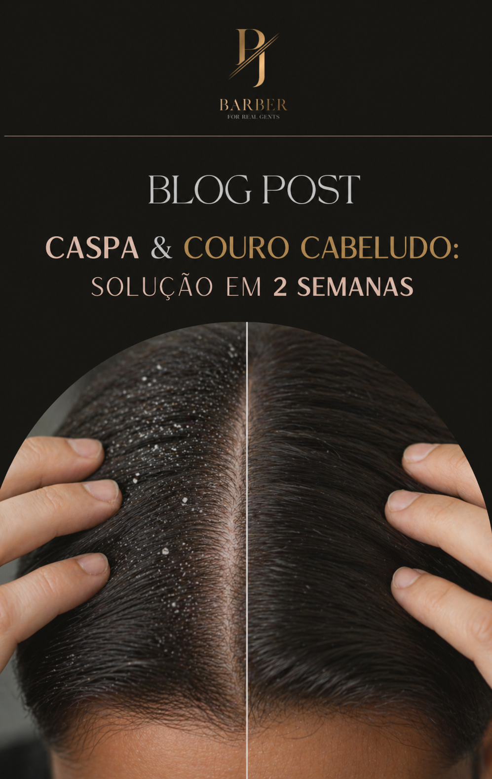 Caspa & Couro Cabeludo: Solução em 2 Semanas