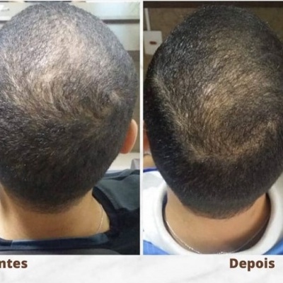 Derma Roller DRS - 540 / 1200 agulhas  |   0.5 - 1.0 mm (for hair regrowth / skin) Derma Roller DRS - 540 / 1200 agulhas  |   0.5 - 1.0 mm (for hair regrowth / skin)