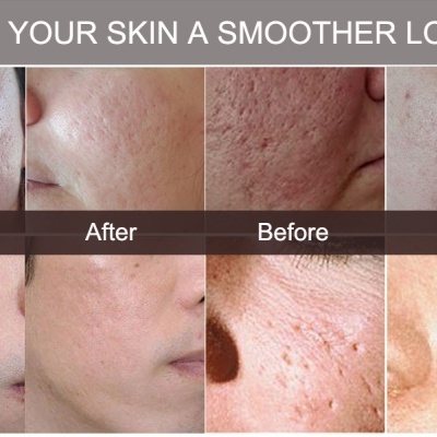 Derma Roller DRS - 540 / 1200 agulhas |   1.5 mm - 2.0 mm | rugas | acne | marcas profundas na pele