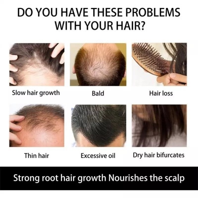 Derma Roller DRS - 540 / 1200 agulhas  |   0.5 - 1.0 mm (for hair regrowth / skin) Derma Roller DRS - 540 / 1200 agulhas  |   0.5 - 1.0 mm (for hair regrowth / skin)