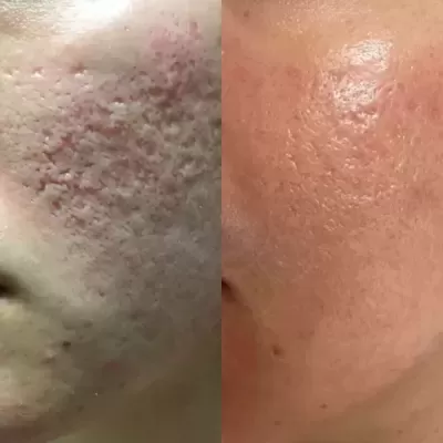 Derma Roller DRS - 540 / 1200 agulhas |   1.5 mm - 2.0 mm | rugas | acne | marcas profundas na pele